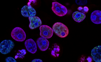 Científicos desarrollan tecnología capaz de detectar algunos tipos de cáncer con análisis de orina 1 Descubren tipos de cáncer a través de la orina